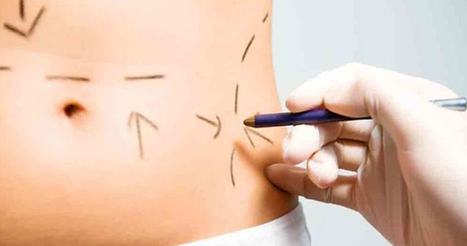 Abdominoplastia: Nuestros servicios de Carpe Diem Clínicas Abdominoplastia: Nuestros servicios de Carpe Diem Clínicas