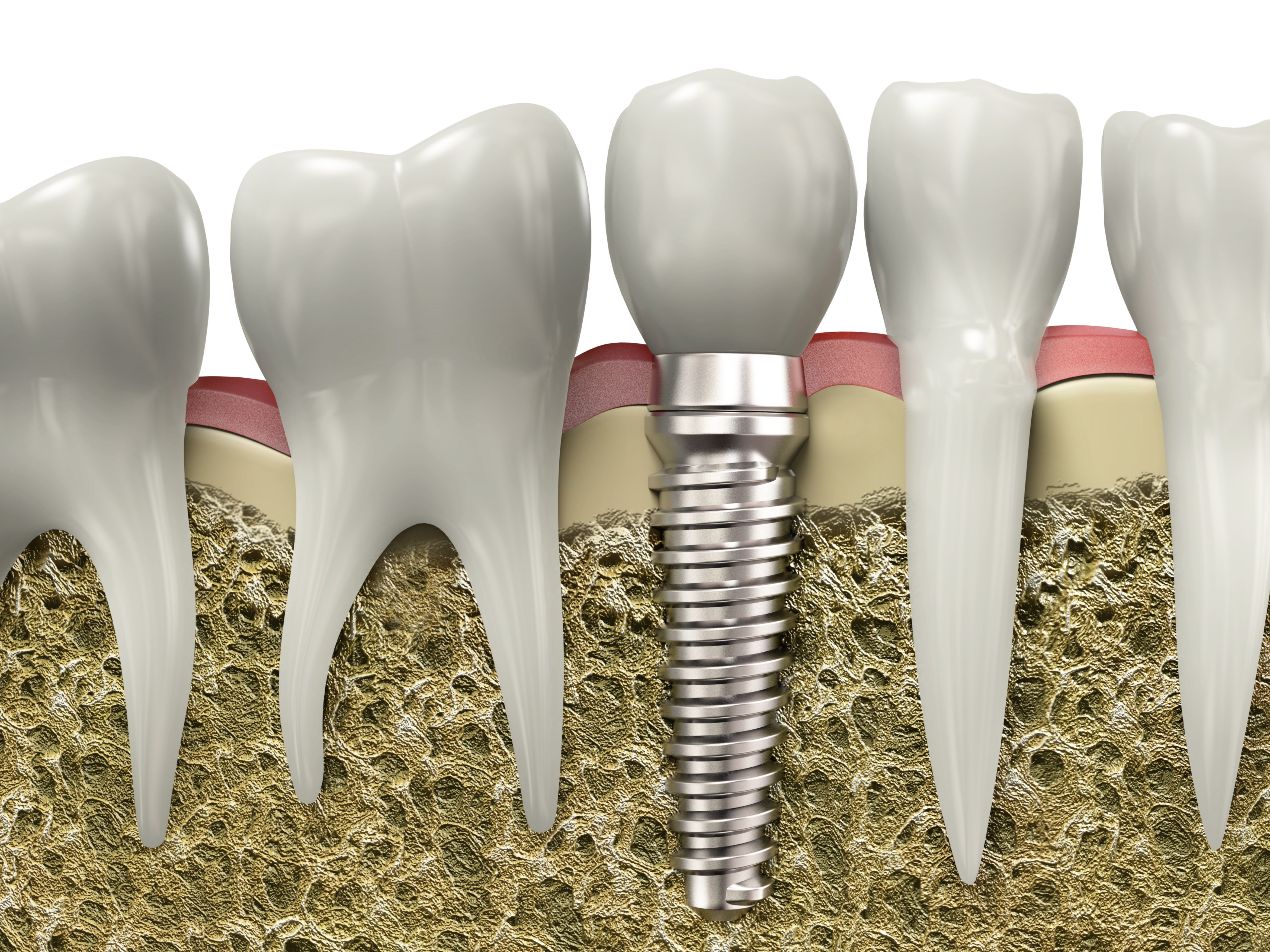 Cirugía e implantología: Tratamientos dentales de Clínica Dental Álvaro Gómez Cirugía e implantología: Tratamientos dentales de Clínica Dental Álvaro Gómez