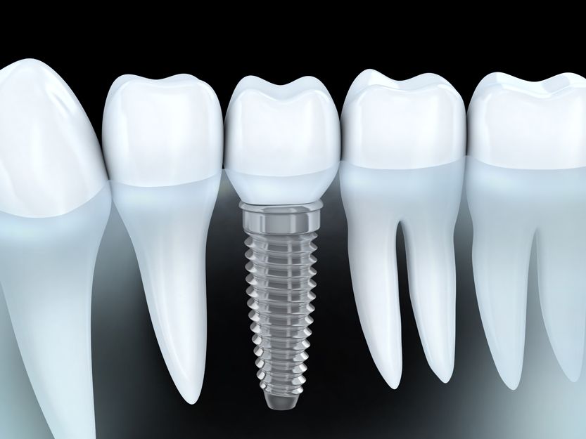 Implantes dentales en Linares