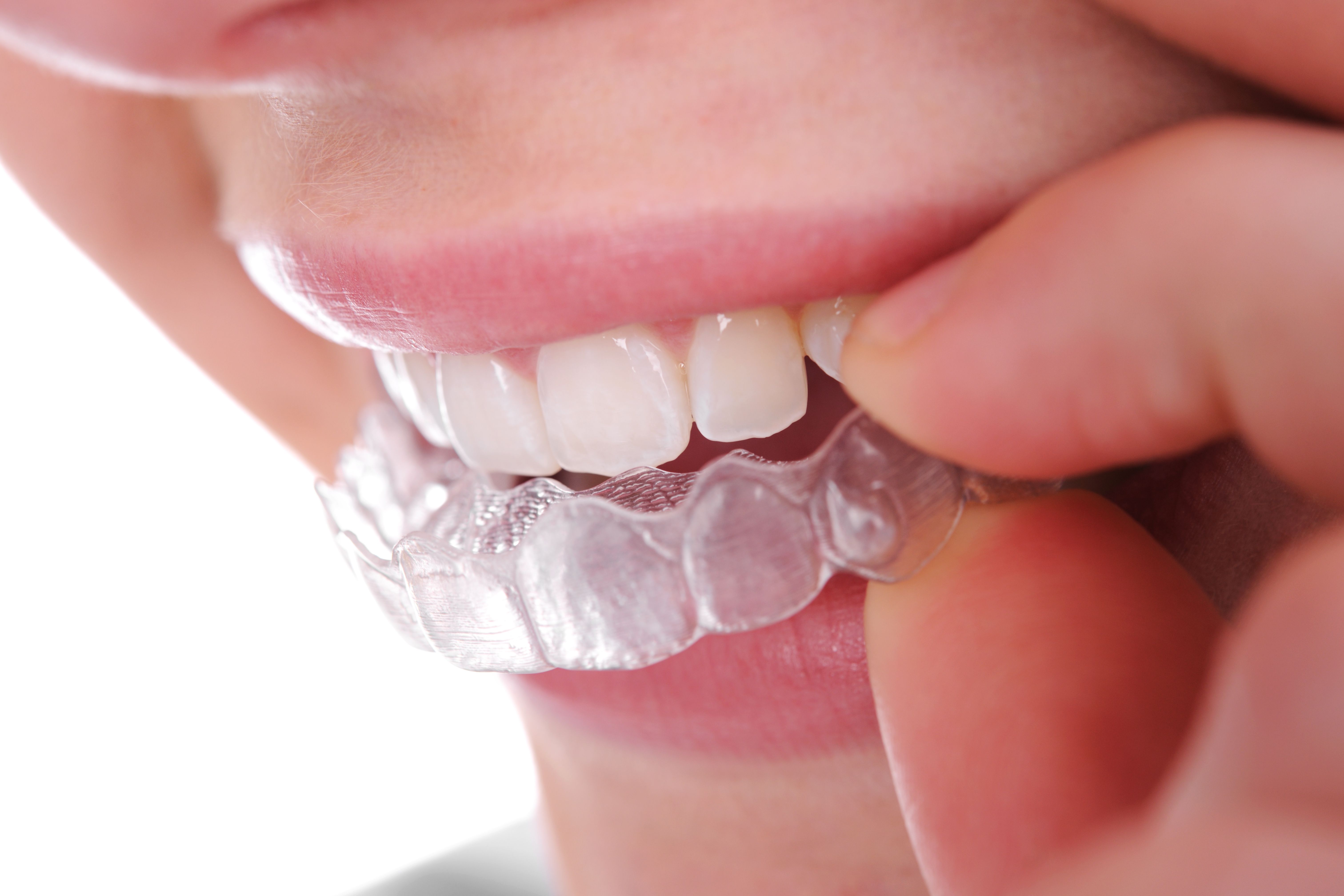Ortodoncia invisible: Tratamientos dentales de Clínica Dental Álvaro Gómez Ortodoncia invisible: Tratamientos dentales de Clínica Dental Álvaro Gómez