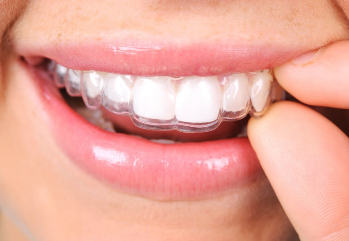 Ortodoncia invisible. Alineadores dentales: Tratamientos de Clínica Dental Liliana Rinaldi Ortodoncia invisible. Alineadores dentales: Tratamientos de Clínica Dental Liliana Rinaldi