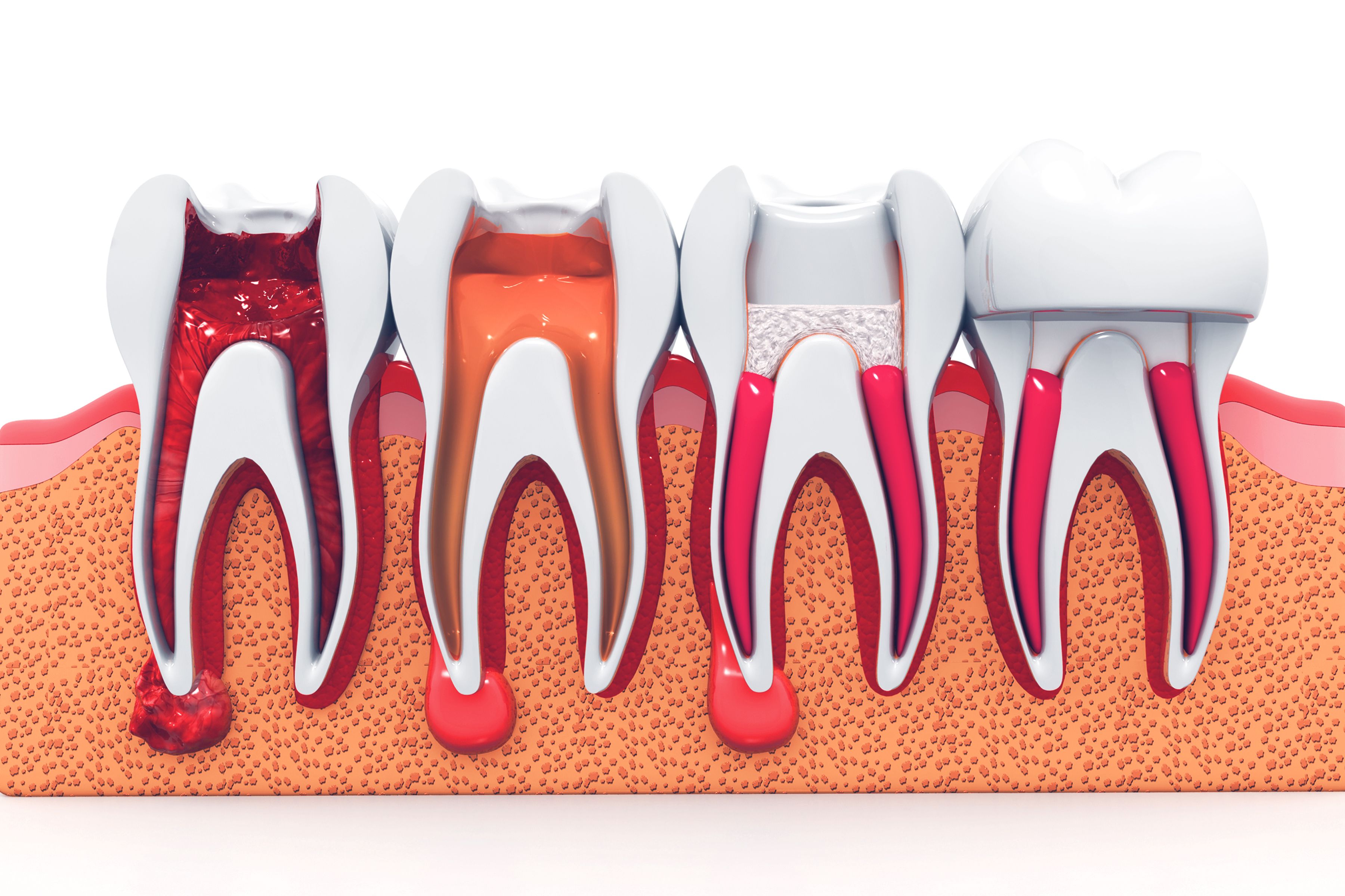 Endodoncia: Tratamientos de Clínica Dental Liliana Rinaldi Endodoncia: Tratamientos de Clínica Dental Liliana Rinaldi