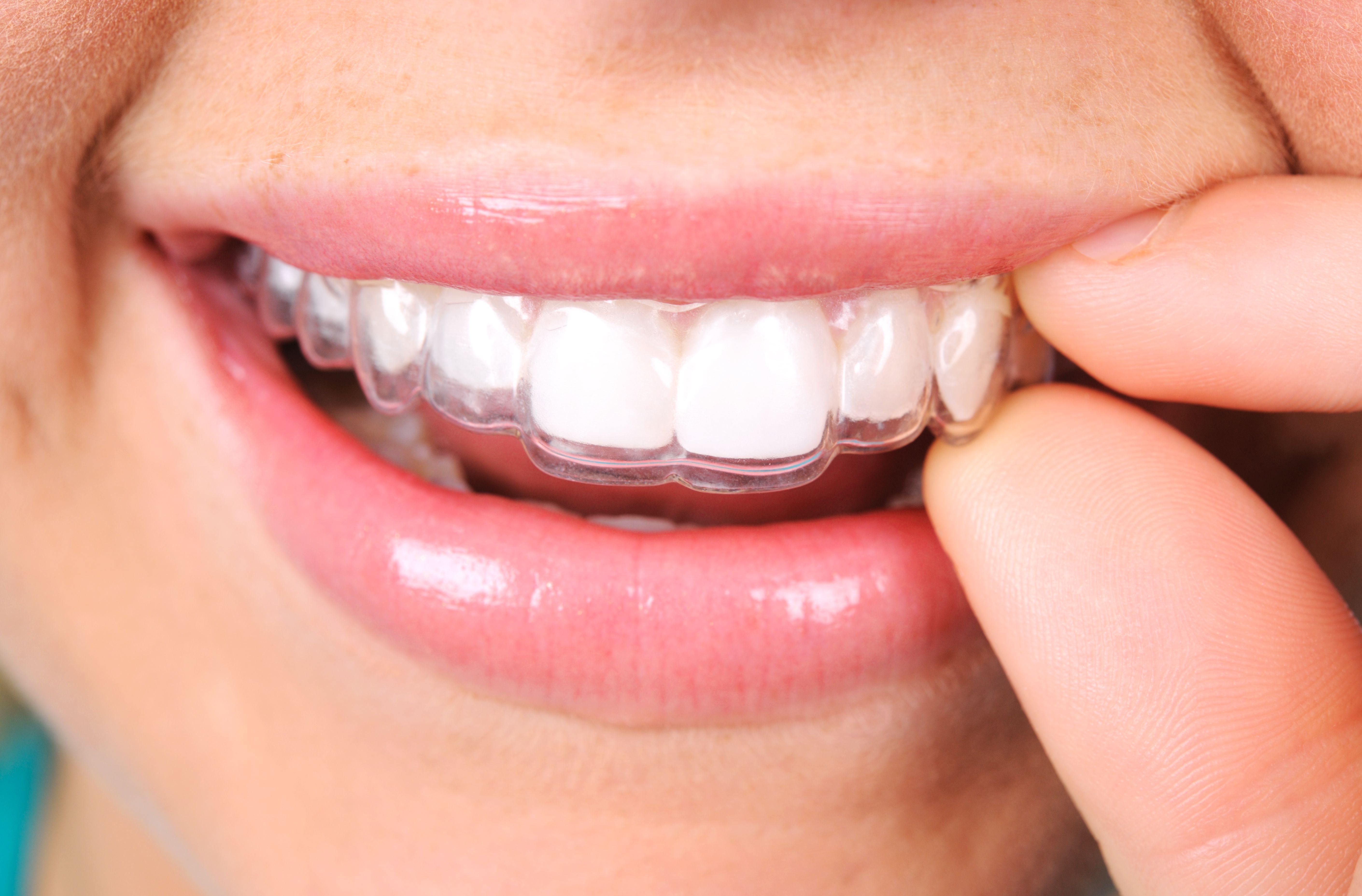 Ortodoncia invisible: Tratamientos de Clínica Dental Liliana Rinaldi Ortodoncia invisible: Tratamientos de Clínica Dental Liliana Rinaldi