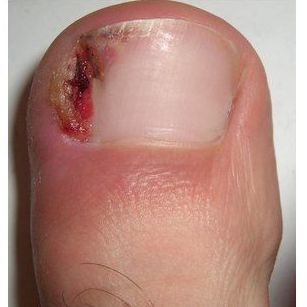 Uñas encarnadas: Tratamientos de Clínica Podológica Fernando Bartolomé Uñas encarnadas: Tratamientos de Clínica Podológica Fernando Bartolomé