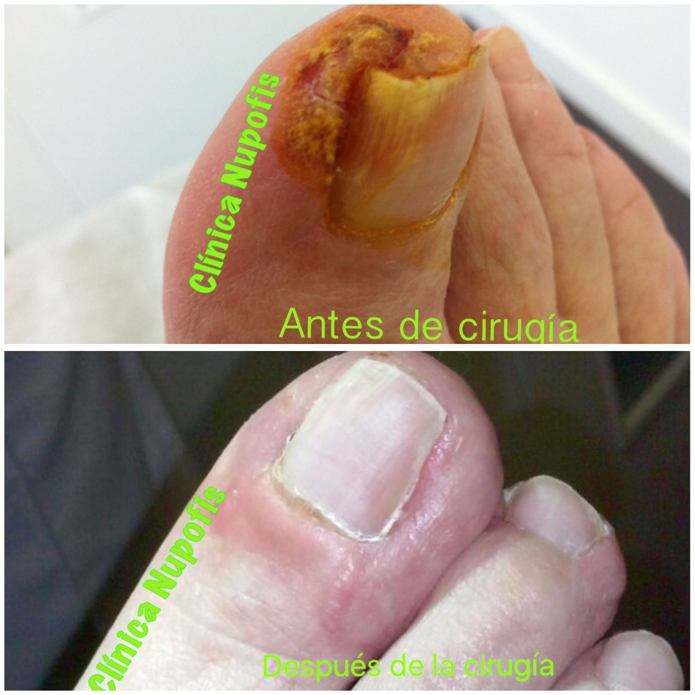 CIRUGIA UÑA ENCARNADA EN CLINICA NUPOFIS CIRUGIA UÑA ENCARNADA EN CLINICA NUPOFIS