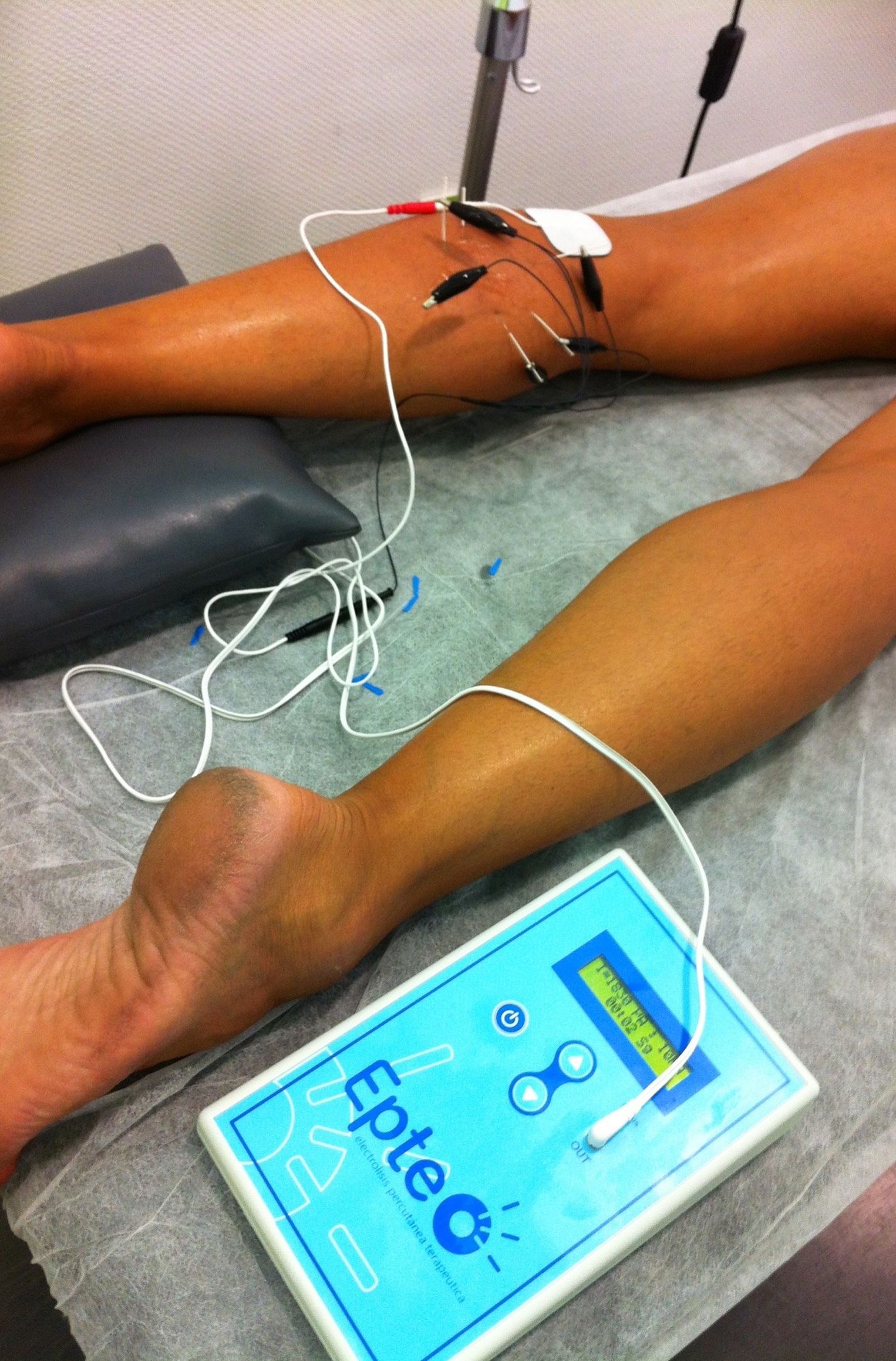 Electrolisis Percutanea Terapéutica EPTE (ECOGUIADA): Especialidades - Tratamientos de Clínica Nupofis Electrolisis Percutanea Terapéutica EPTE (ECOGUIADA): Especialidades - Tratamientos de Clínica Nupofis