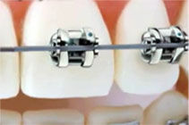 Brackets: Aparatos de Clínica Ibaseta Brackets: Aparatos de Clínica Ibaseta