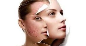 Peeling químico: Tratamientos y cosméticos de Etherma Peeling químico: Tratamientos y cosméticos de Etherma