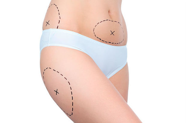 LIPOSUCCIÓN: Cirugías habituales de Dr. Agustín Ballesteros - Cirujano Plástico LIPOSUCCIÓN: Cirugías habituales de Dr. Agustín Ballesteros - Cirujano Plástico