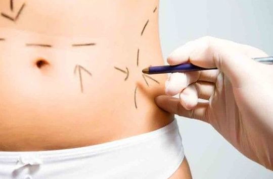 ABDOMINOPLASTIA: Cirugías habituales de Dr. Agustín Ballesteros - Cirujano Plástico ABDOMINOPLASTIA: Cirugías habituales de Dr. Agustín Ballesteros - Cirujano Plástico