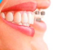 Ortodoncia: Tratamientos de Dental Clínic Palamós