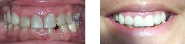 CARILLAS DE COMPOSITE CON TÉCNICA ESTRATIFICADA: Tratamientos de Dental Clínic Palamós