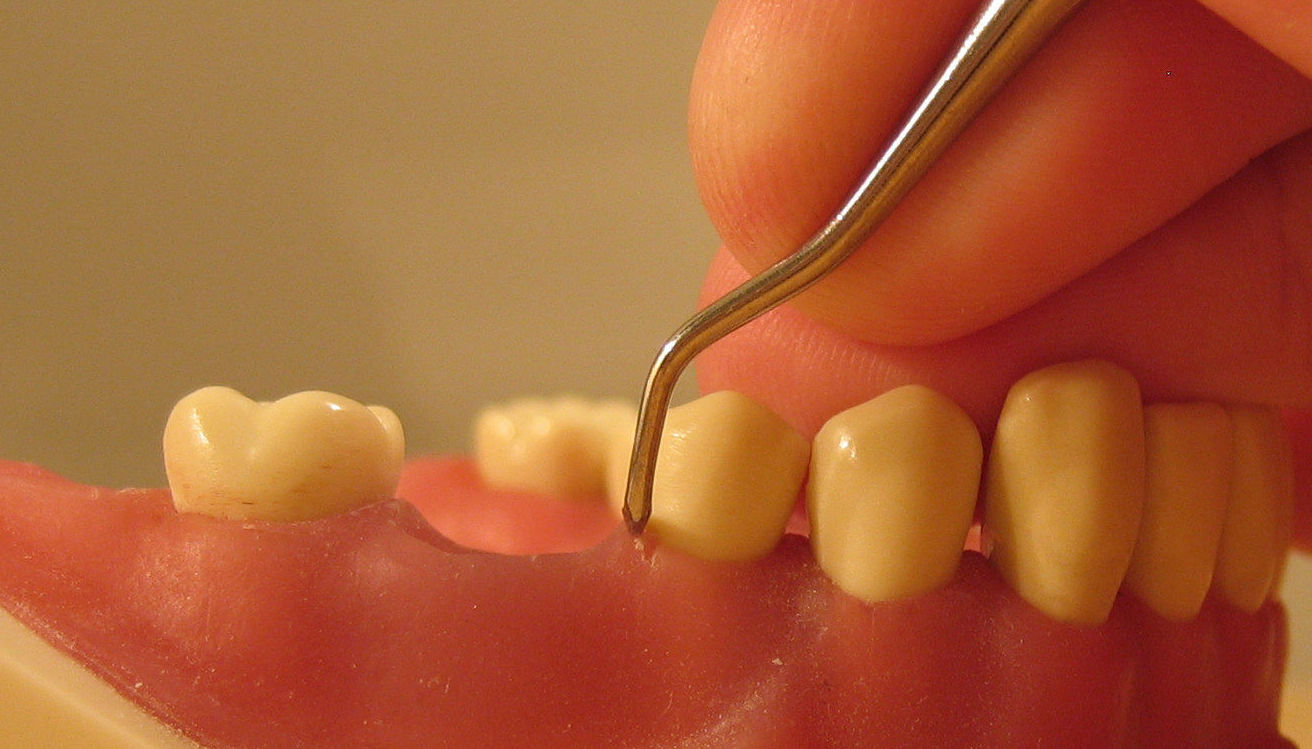 Periodoncia: Servicios de Vicálvaro Dental - Clínica Dental Periodoncia: Servicios de Vicálvaro Dental - Clínica Dental