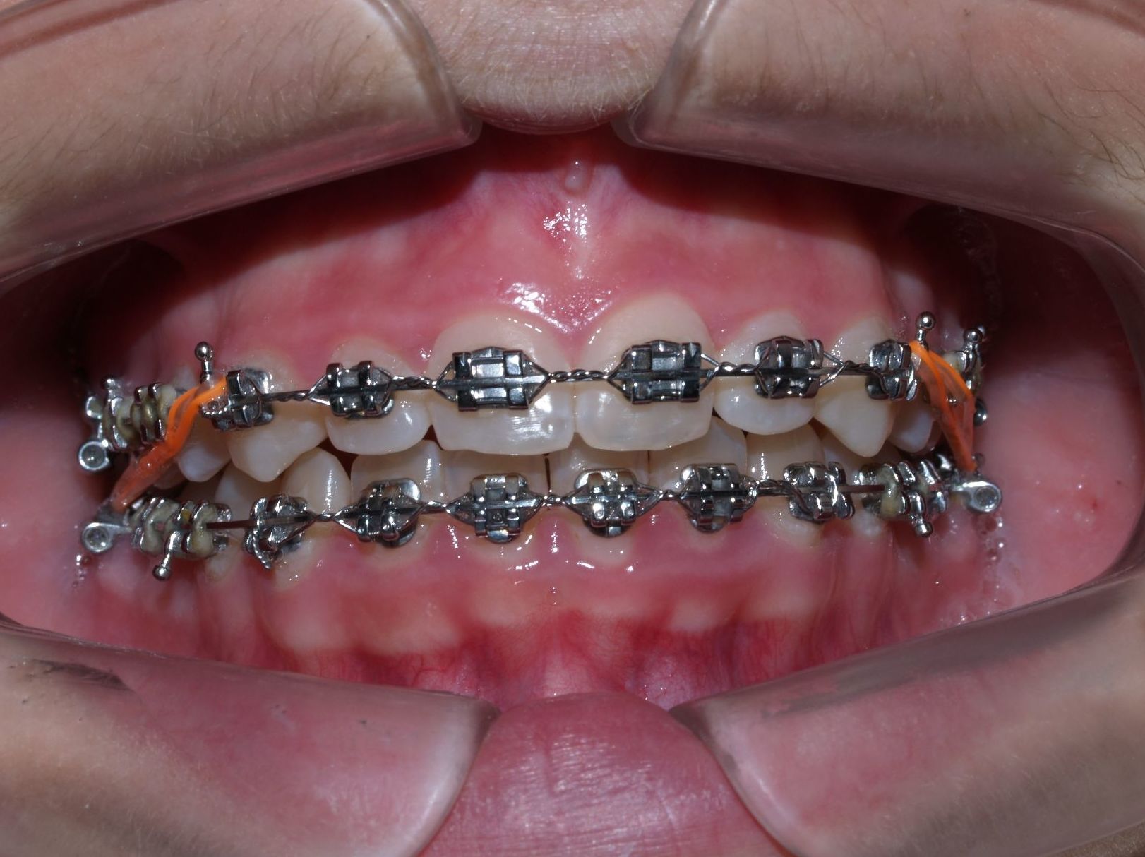 Tratamiento ortodóncico convencional: Servicios de Vicálvaro Dental - Clínica Dental Tratamiento ortodóncico convencional: Servicios de Vicálvaro Dental - Clínica Dental