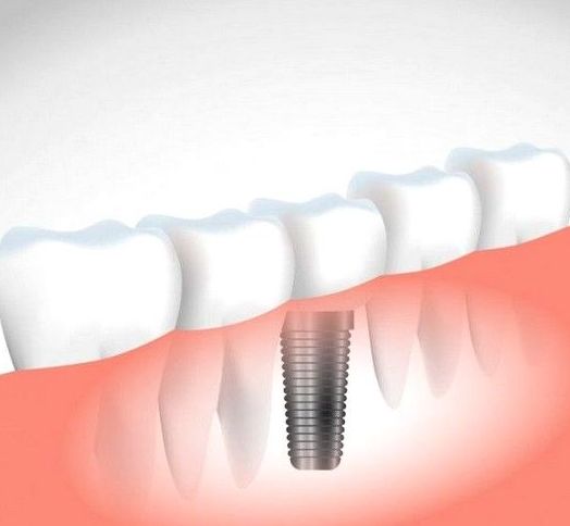 Implantes: Servicios de Vicálvaro Dental - Clínica Dental Implantes: Servicios de Vicálvaro Dental - Clínica Dental