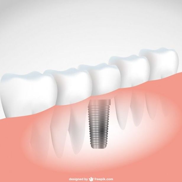 Implantes: Servicios de Clínica Dental Alodent