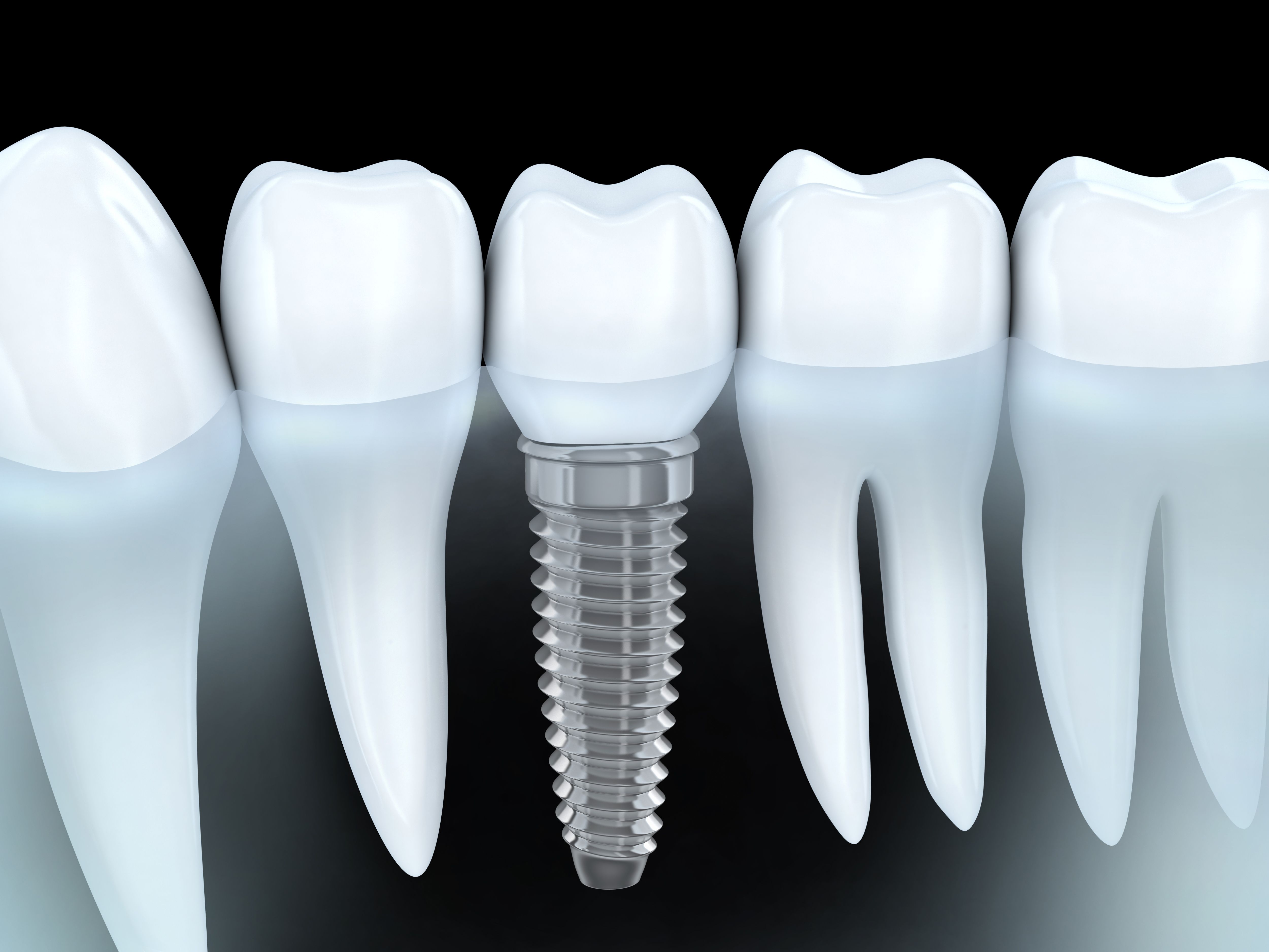 Cirugía preimplantológica: Especialidades de Clínica Dental Villa Vigil y Asociados, S.L. Cirugía preimplantológica: Especialidades de Clínica Dental Villa Vigil y Asociados, S.L.