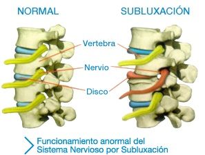 1.3 Subluxación: Servicios de Centros Valverde 1.3 Subluxación: Servicios de Centros Valverde