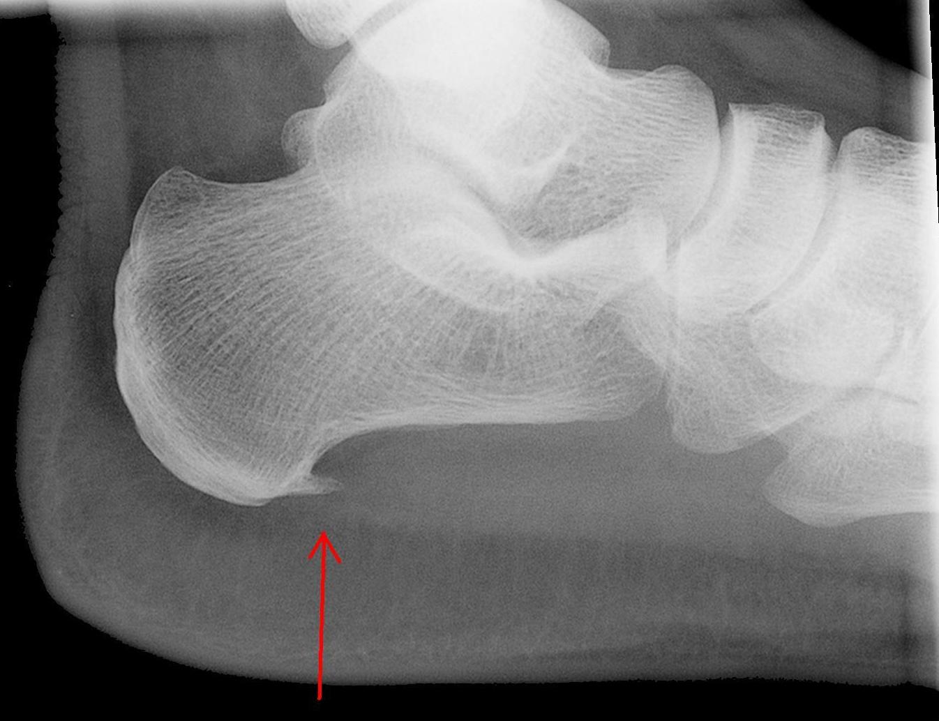 Fascitis plantar: Tratamientos de Pacientes particulares