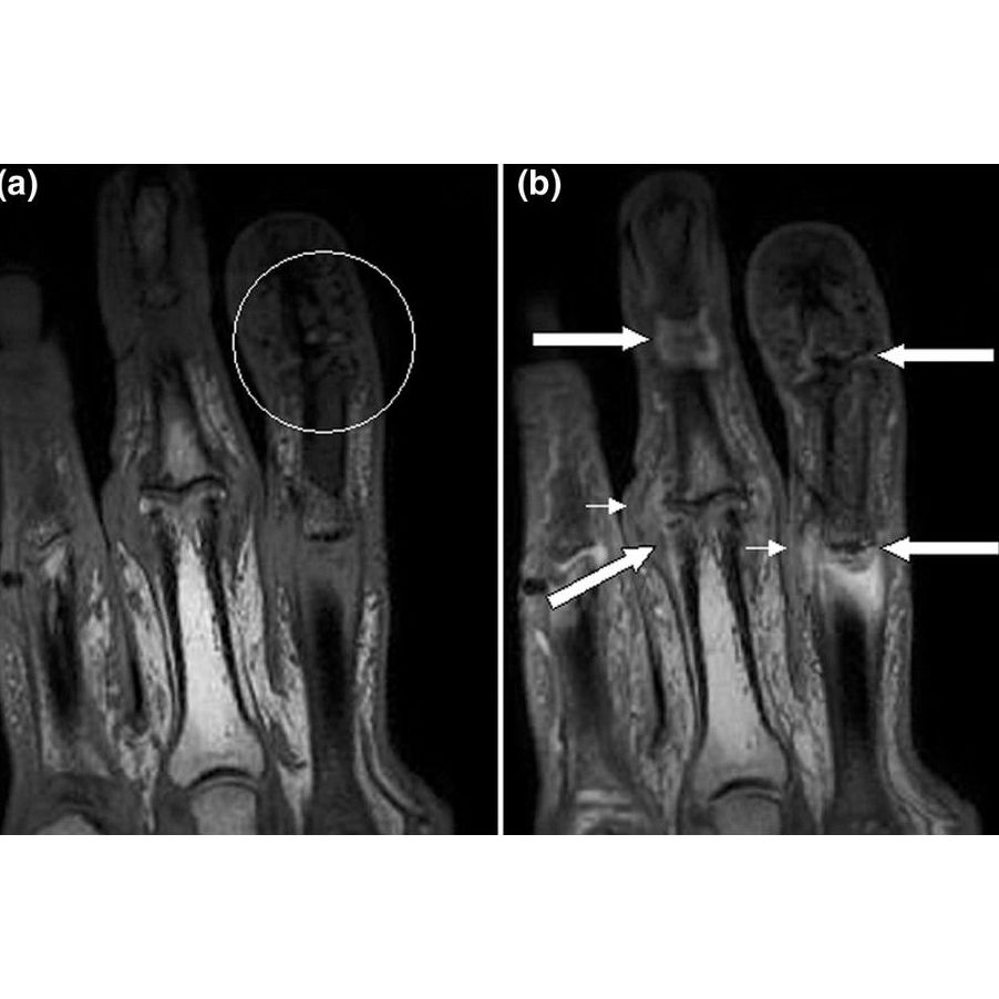 Artritis psoriásica: Tratamientos de Pacientes particulares