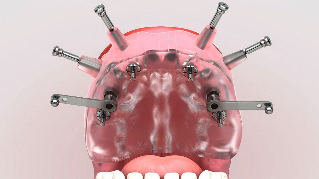 Implantes dentales: Servicios de Centro Dental Integral Mª Azucena Plata Vega Implantes dentales: Servicios de Centro Dental Integral Mª Azucena Plata Vega