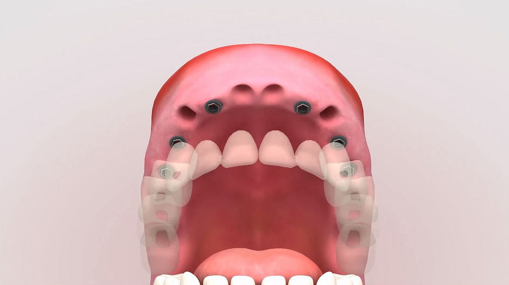 Implantes dentales: Servicios de Centro Dental Integral Mª Azucena Plata Vega Implantes dentales: Servicios de Centro Dental Integral Mª Azucena Plata Vega
