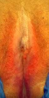 Liquen escleroso: Dermatología y Dermoestética de Dermatología Socorro Fierro Liquen escleroso: Dermatología y Dermoestética de Dermatología Socorro Fierro