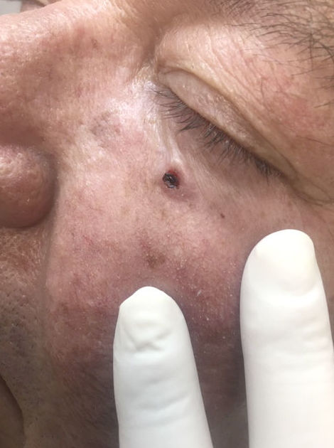 Carcinoma Basocelular Carcinoma Basocelular
