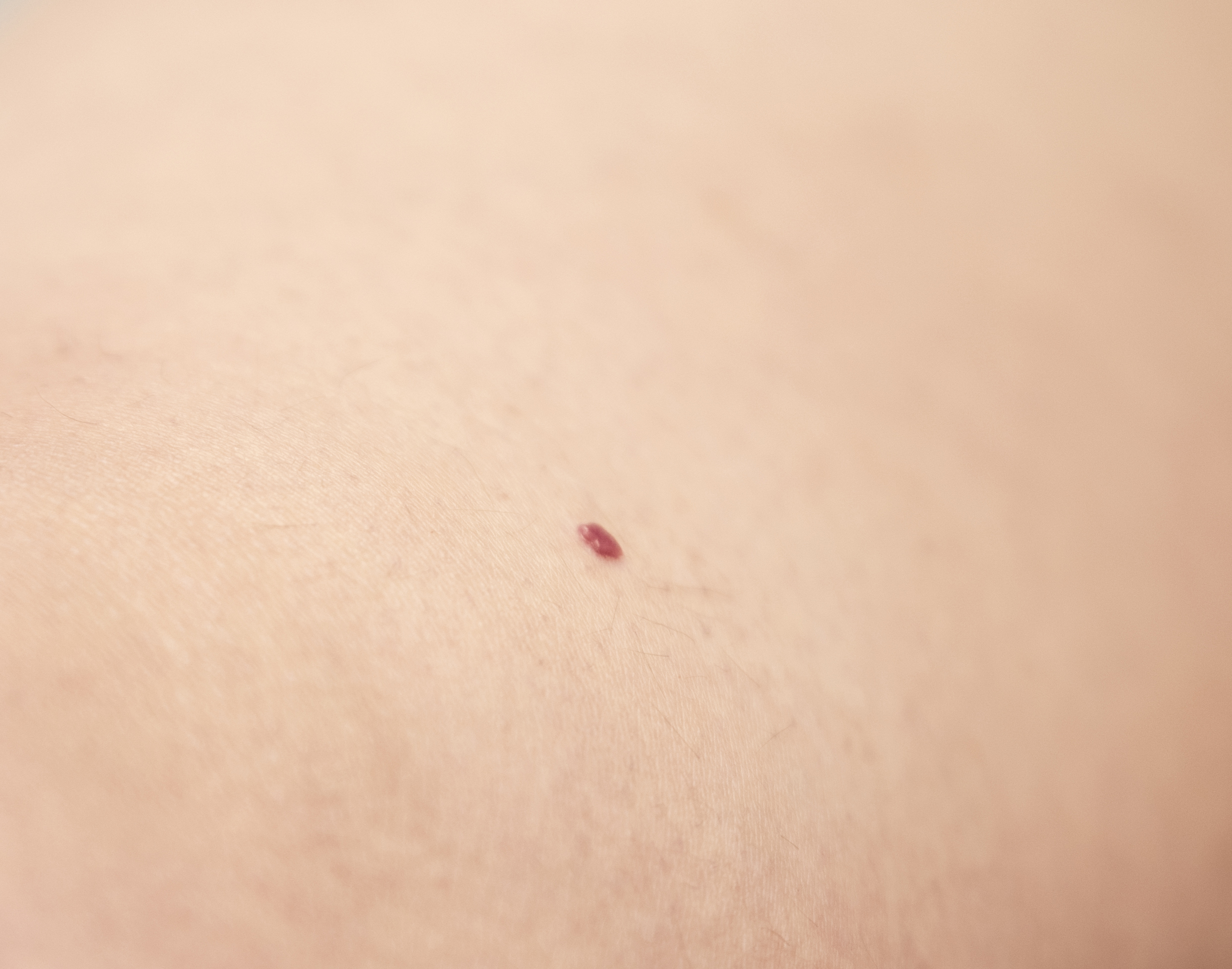 Nevus rubí Nevus rubí