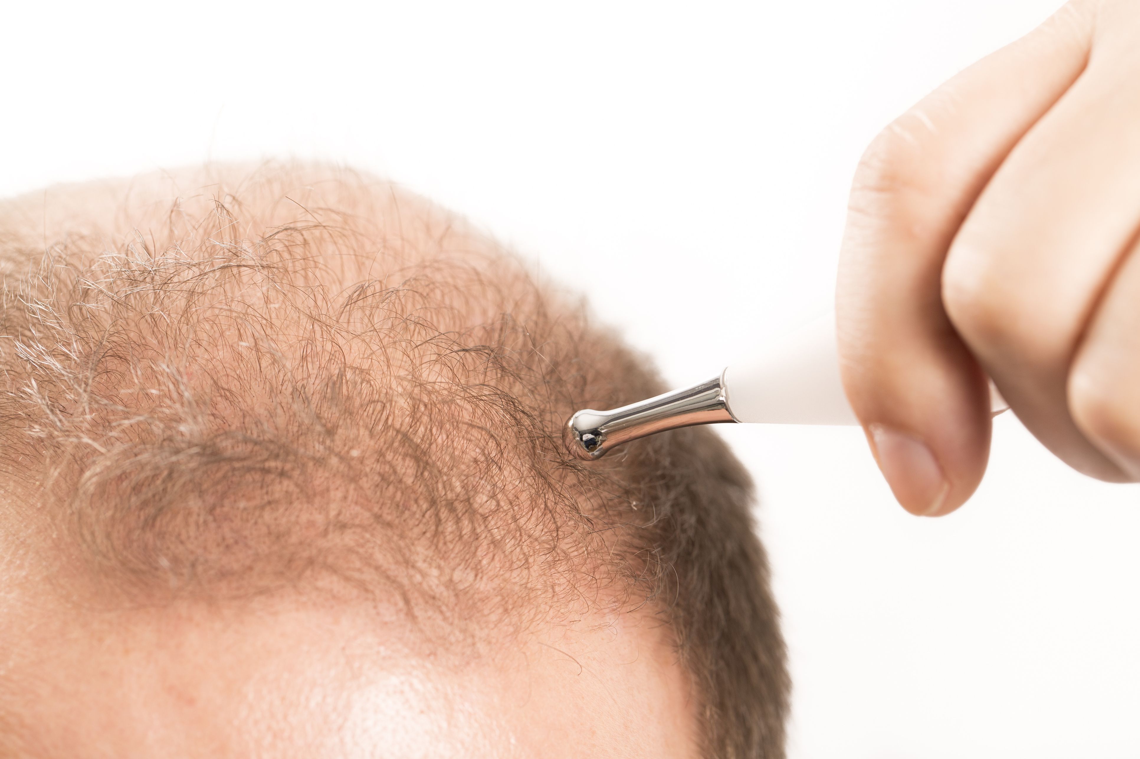 Alopecia: Dermatología y Dermoestética de Dermatología Socorro Fierro Alopecia: Dermatología y Dermoestética de Dermatología Socorro Fierro