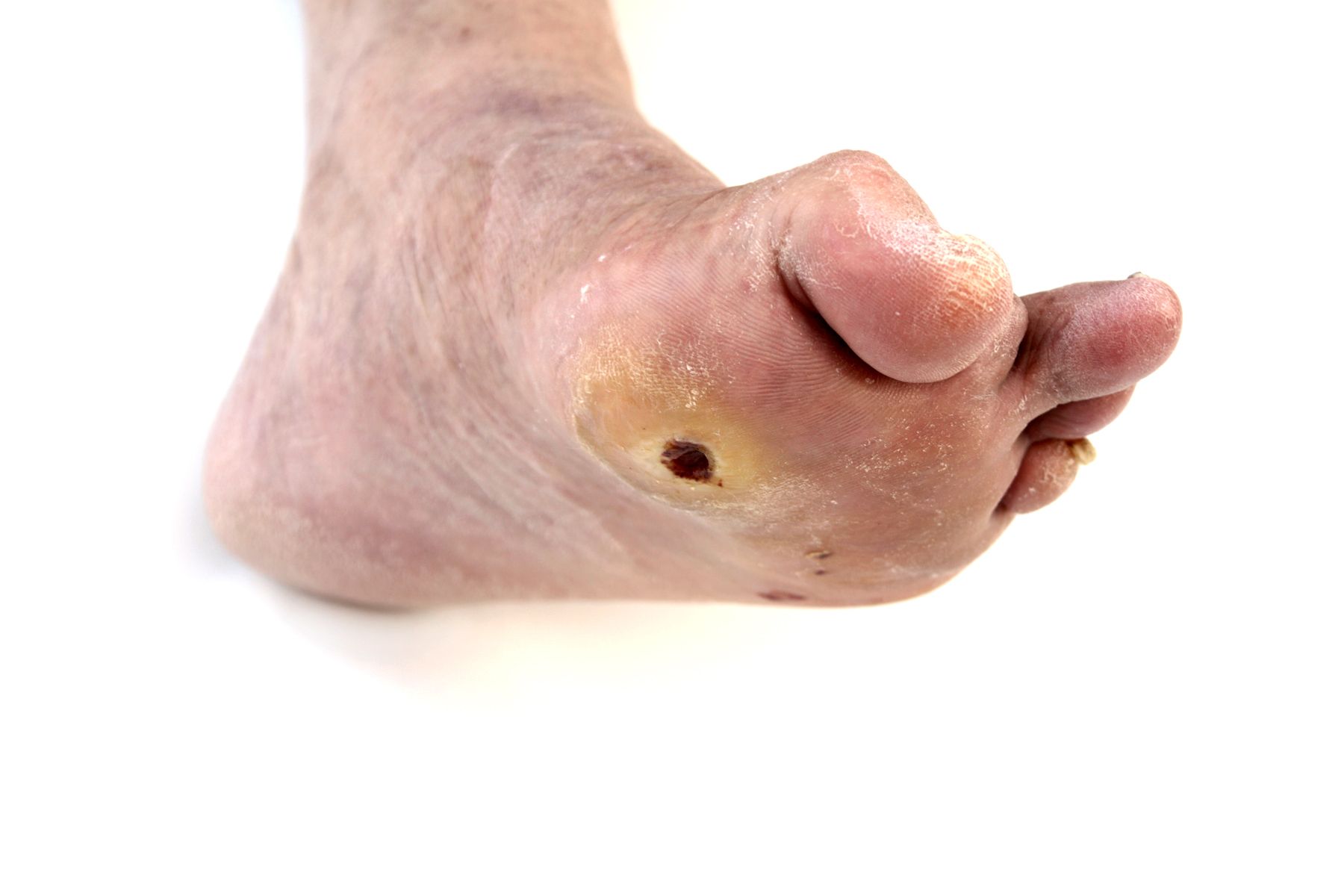 Ulceras: Dermatología y Dermoestética de Dermatología Socorro Fierro Ulceras: Dermatología y Dermoestética de Dermatología Socorro Fierro