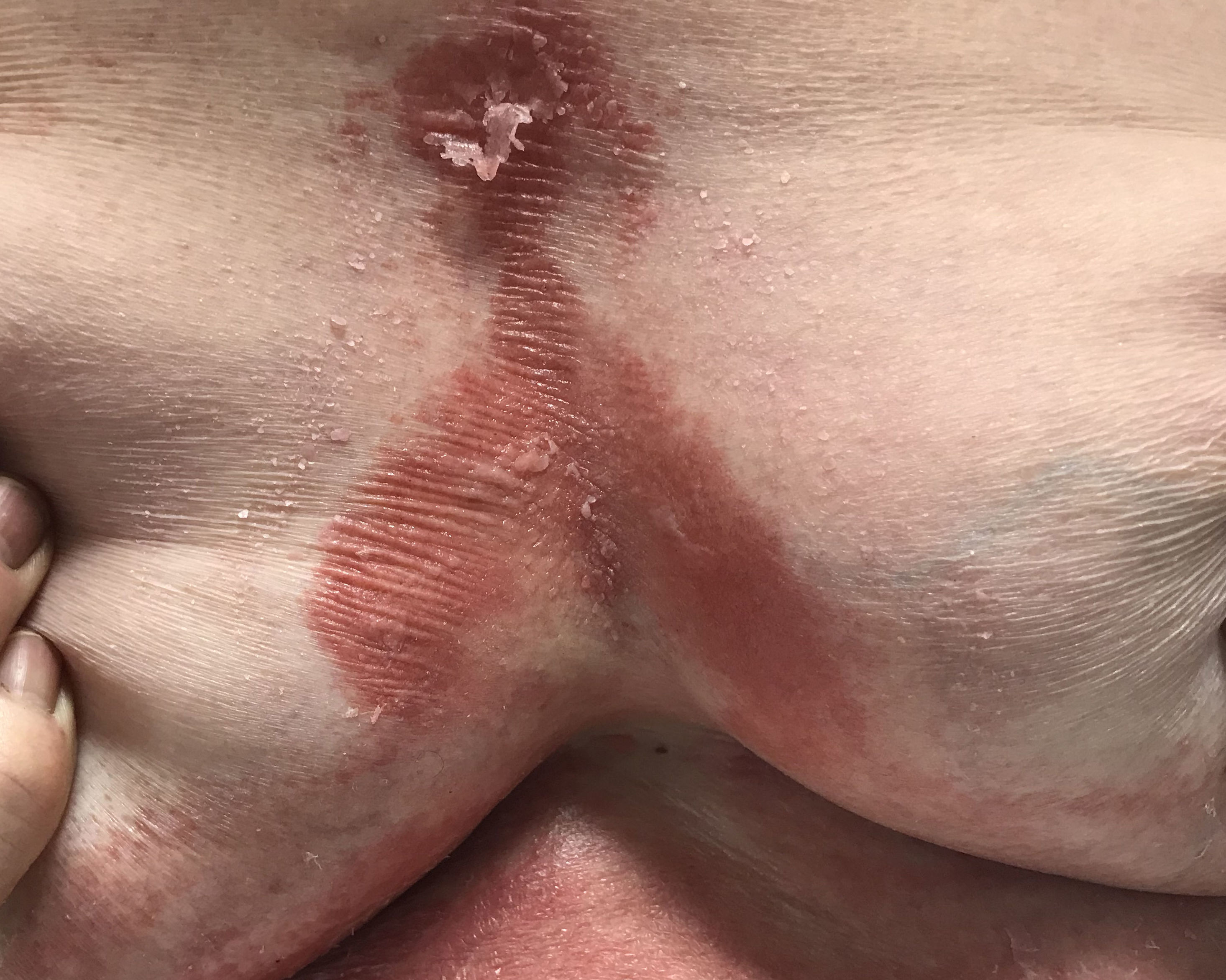 Psoriasis Invertida Psoriasis Invertida