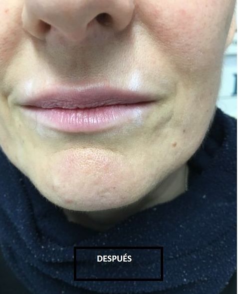 Relleno de Ácido Hialurónico: Dermatología y Dermoestética de Dermatología Socorro Fierro Relleno de Ácido Hialurónico: Dermatología y Dermoestética de Dermatología Socorro Fierro