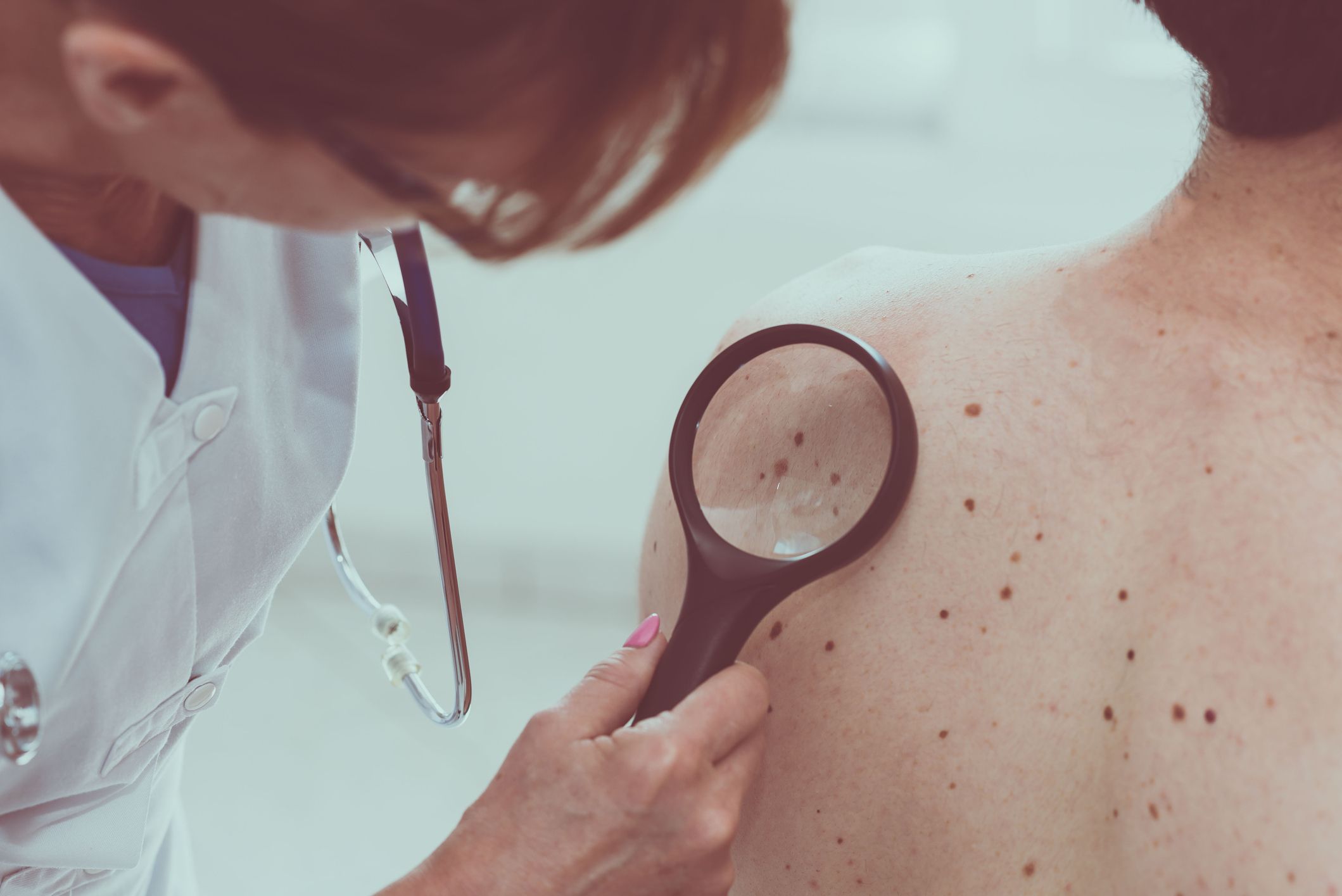 Queratosis seborreicas: Dermatología y Dermoestética de Dermatología Socorro Fierro Queratosis seborreicas: Dermatología y Dermoestética de Dermatología Socorro Fierro