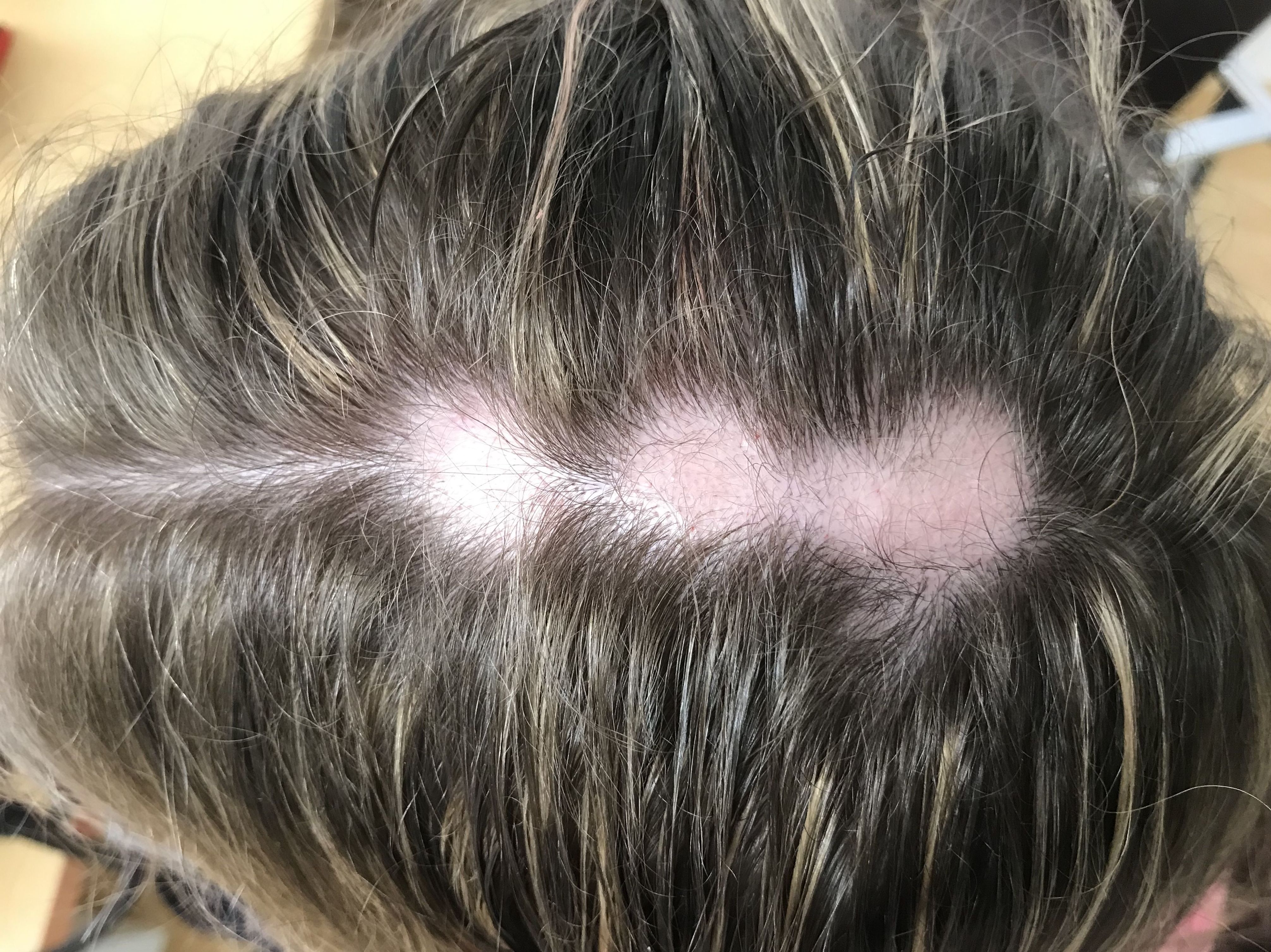Placas de alopecia Placas de alopecia