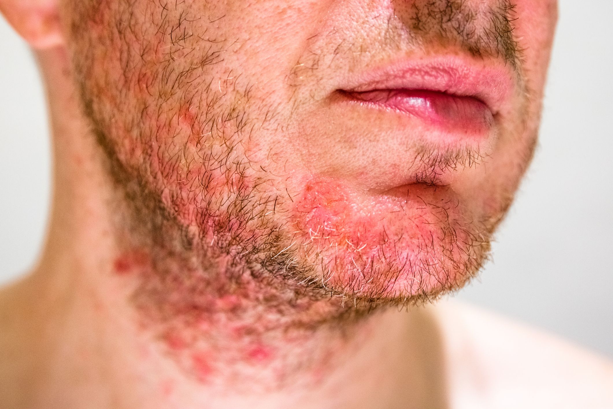 Dermatitis seborreica: Dermatología y Dermoestética de Dermatología Socorro Fierro Dermatitis seborreica: Dermatología y Dermoestética de Dermatología Socorro Fierro