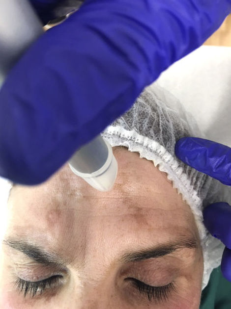 Tratamiento de melasma con Microagujas Tratamiento de melasma con Microagujas