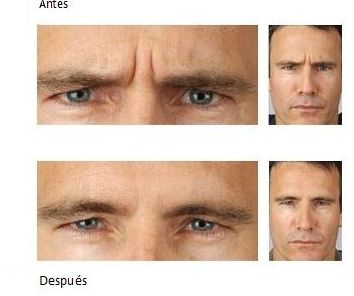 Botox: Dermatología y Dermoestética de Dermatología Socorro Fierro Botox: Dermatología y Dermoestética de Dermatología Socorro Fierro