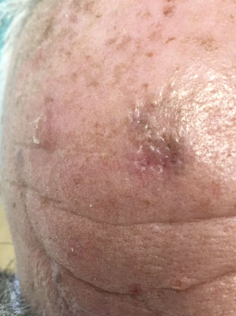 Carcinoma Basocelular sobre queratosis seborreica Carcinoma Basocelular sobre queratosis seborreica