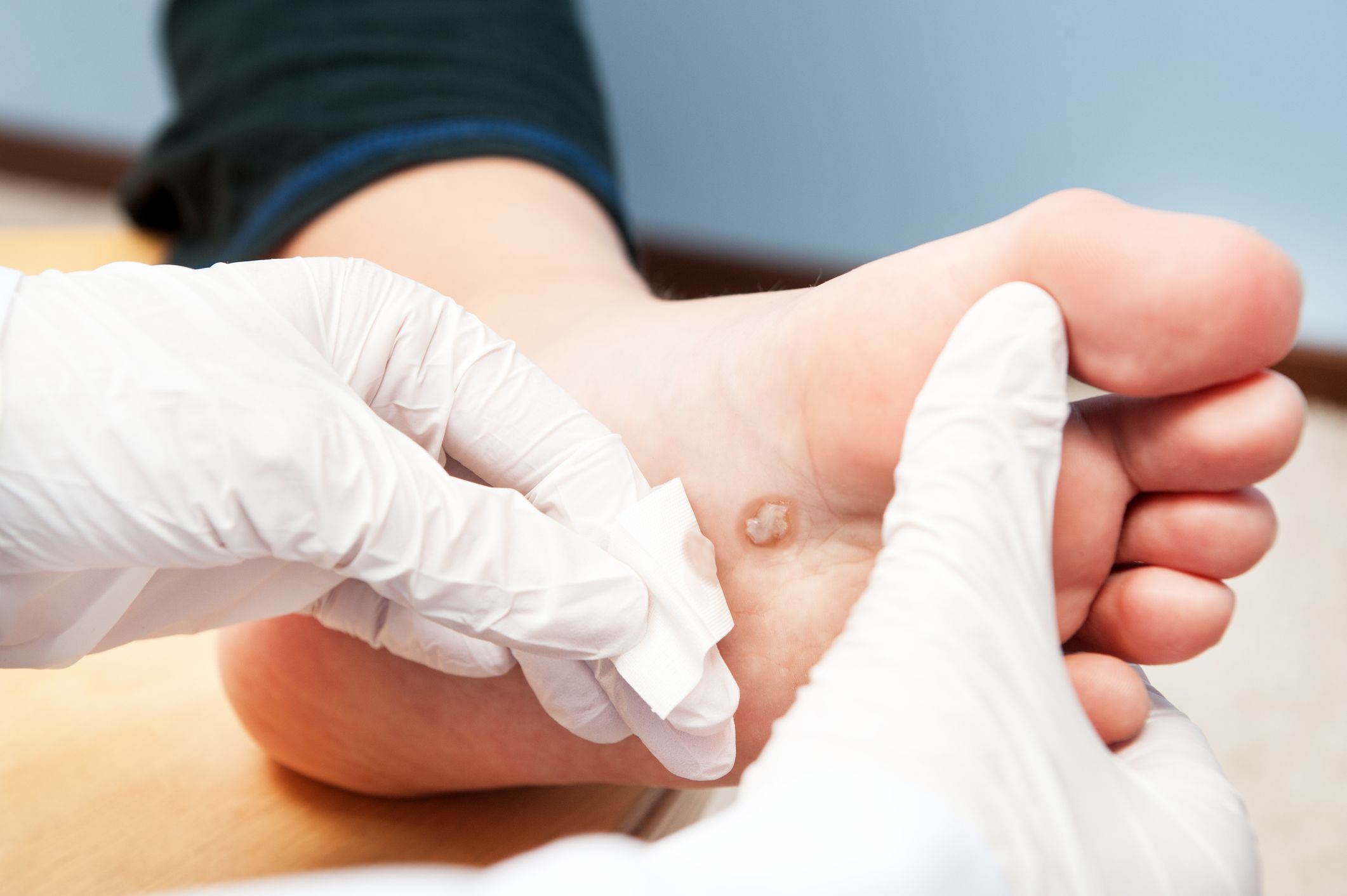 Verrugas: Dermatología y Dermoestética de Dermatología Socorro Fierro Verrugas: Dermatología y Dermoestética de Dermatología Socorro Fierro