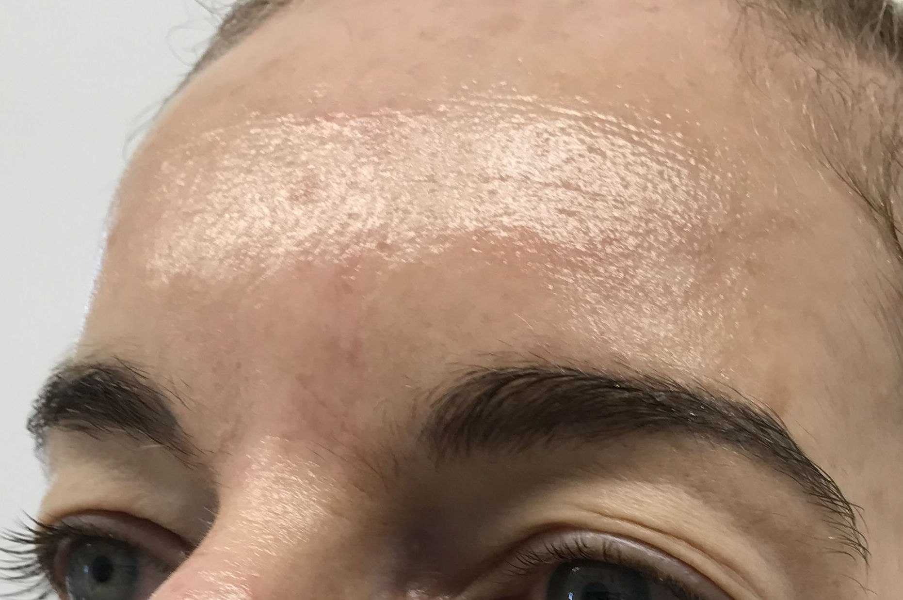 Tratamiento con Botox Tratamiento con Botox