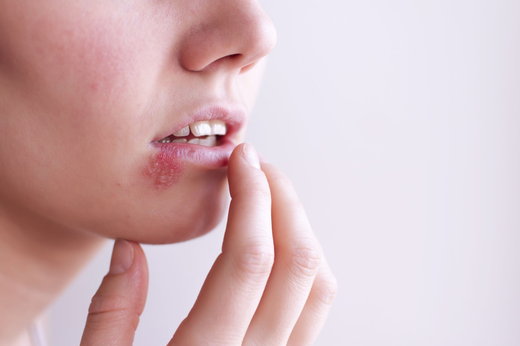 Herpes simple (VHS): Dermatología y Dermoestética de Dermatología Socorro Fierro Herpes simple (VHS): Dermatología y Dermoestética de Dermatología Socorro Fierro