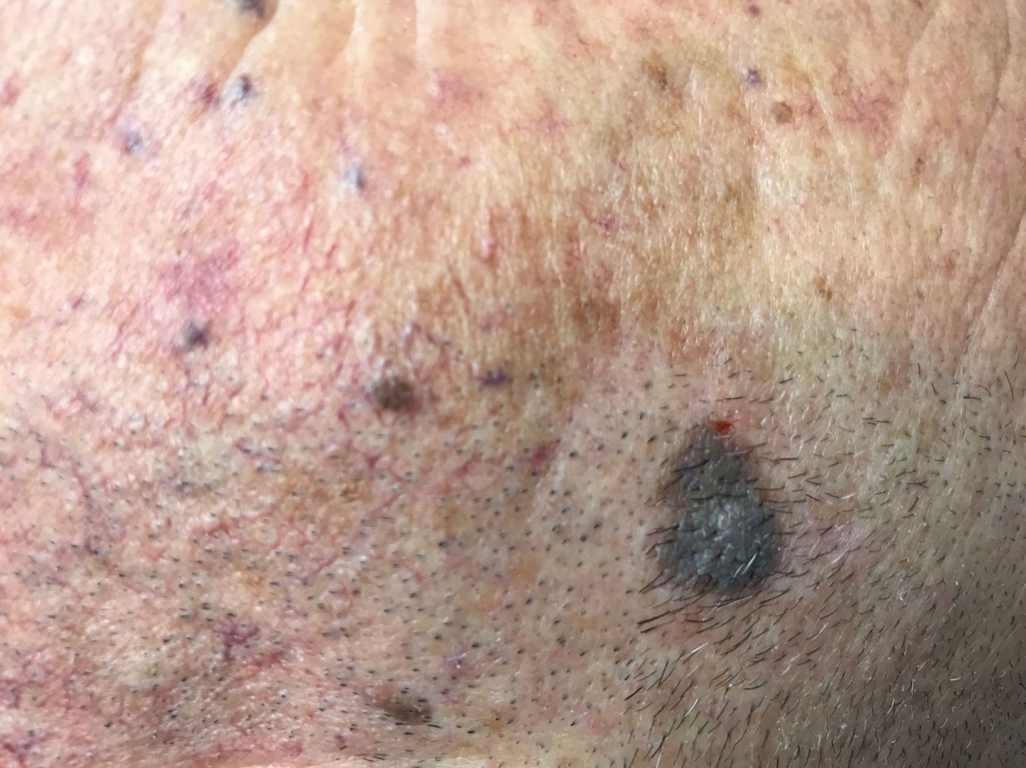 Queratosis seborreica y angioma Queratosis seborreica y angioma