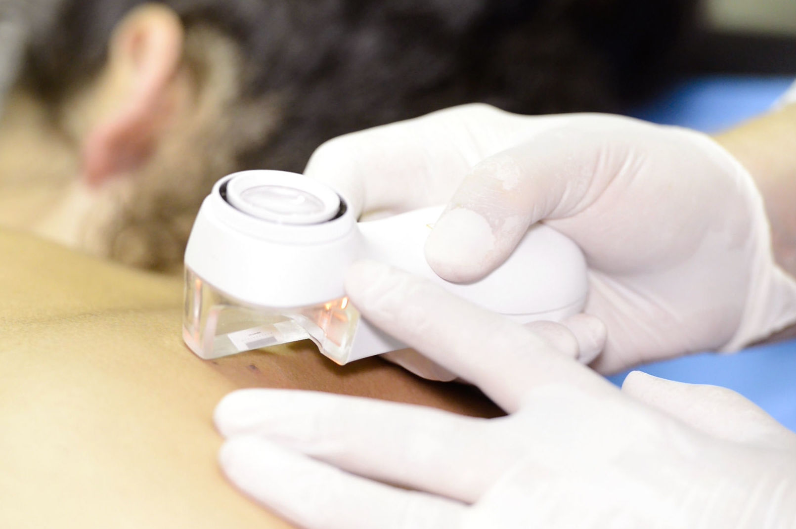 Cánceres no melanoma: Dermatología y Dermoestética de Dermatología Socorro Fierro Cánceres no melanoma: Dermatología y Dermoestética de Dermatología Socorro Fierro