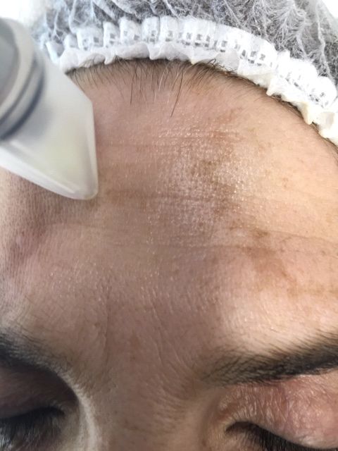 Melasma: Dermatología y Dermoestética de Dermatología Socorro Fierro Melasma: Dermatología y Dermoestética de Dermatología Socorro Fierro