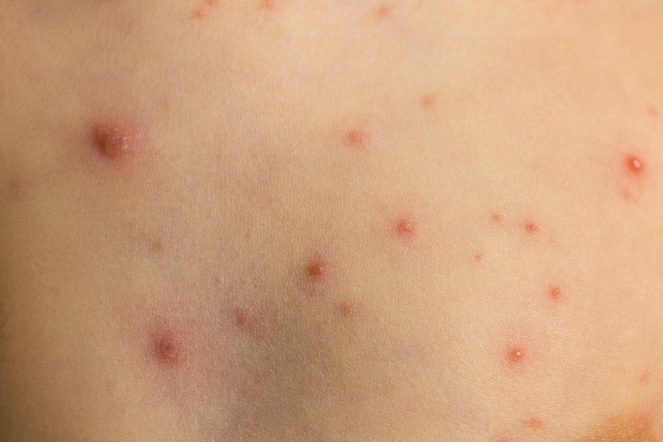 Moluscos Contagiosos: Dermatología y Dermoestética de Dermatología Socorro Fierro Moluscos Contagiosos: Dermatología y Dermoestética de Dermatología Socorro Fierro