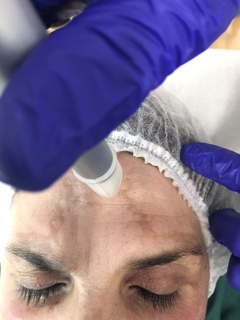 Melasma: Dermatología y Dermoestética de Dermatología Socorro Fierro Melasma: Dermatología y Dermoestética de Dermatología Socorro Fierro