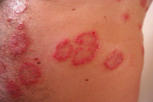 Psoriasis: Dermatología y Dermoestética de Dermatología Socorro Fierro Psoriasis: Dermatología y Dermoestética de Dermatología Socorro Fierro