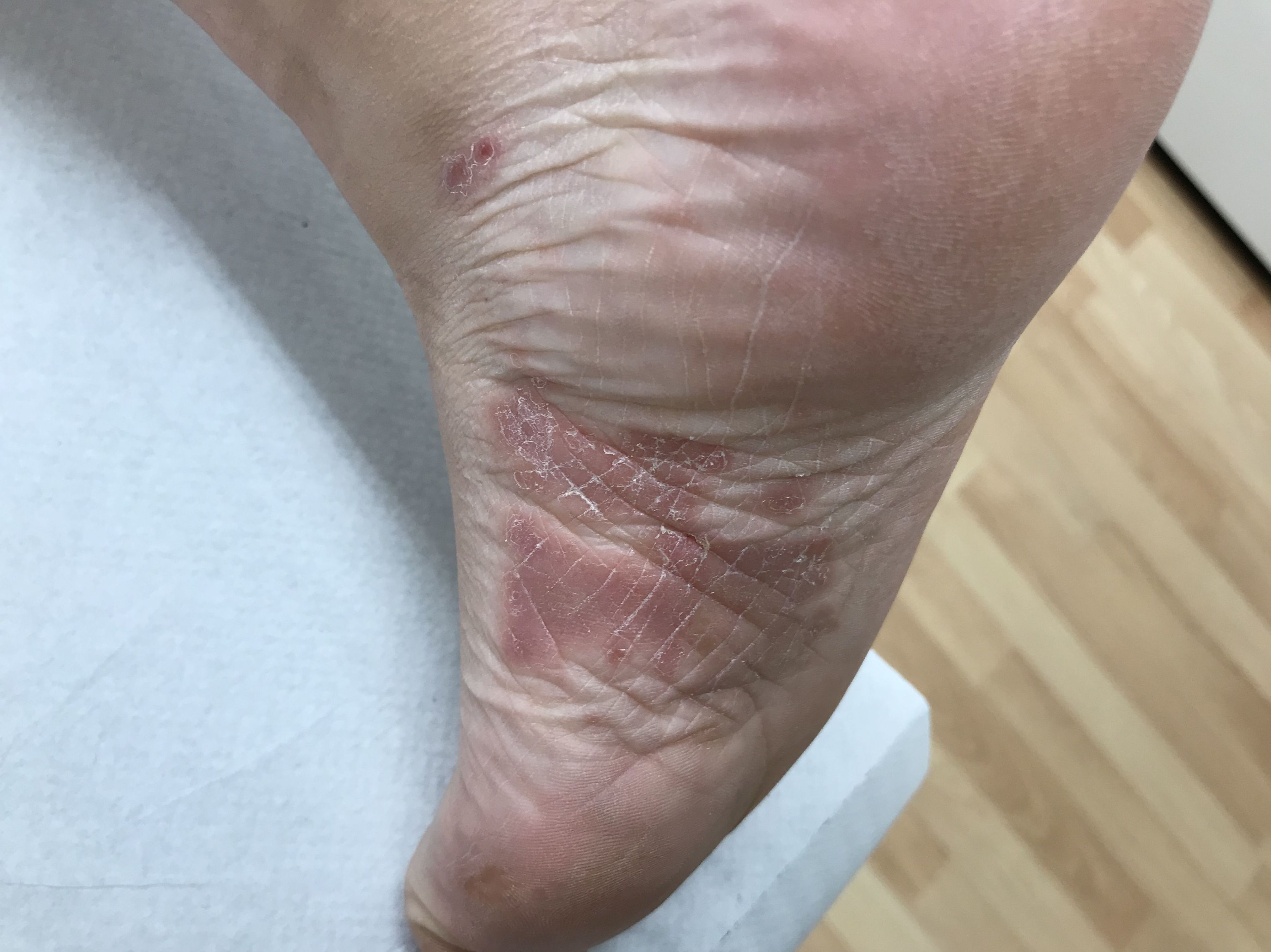 Psoriasis Plantar Psoriasis Plantar