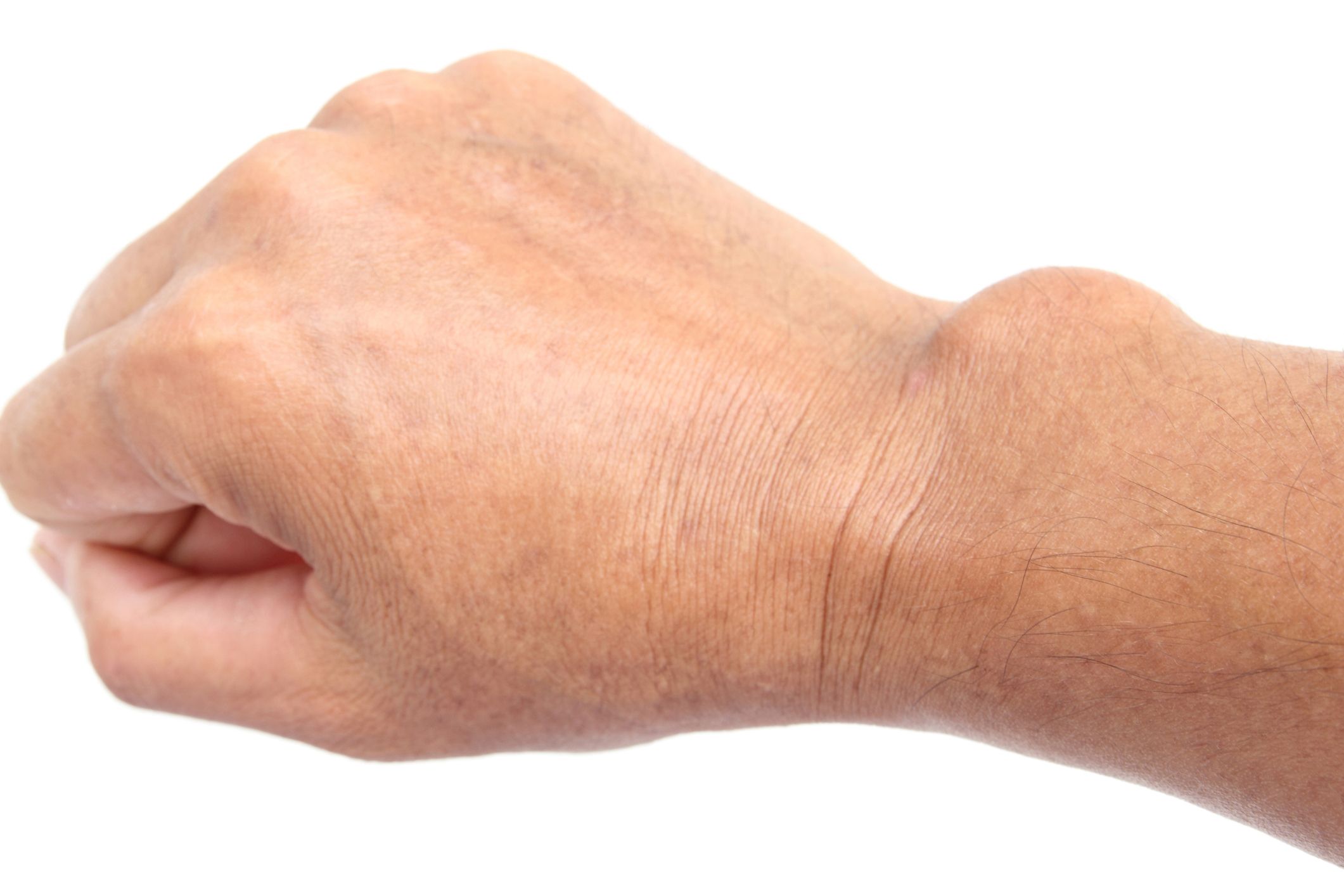 Quistes: Dermatología y Dermoestética de Dermatología Socorro Fierro Quistes: Dermatología y Dermoestética de Dermatología Socorro Fierro